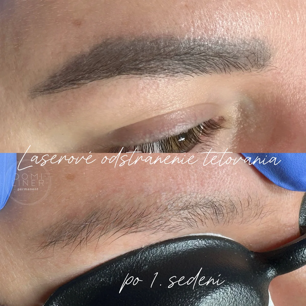 Laser tattoo removal – after 1st session